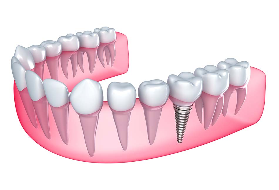 Full Arch Dental Implants